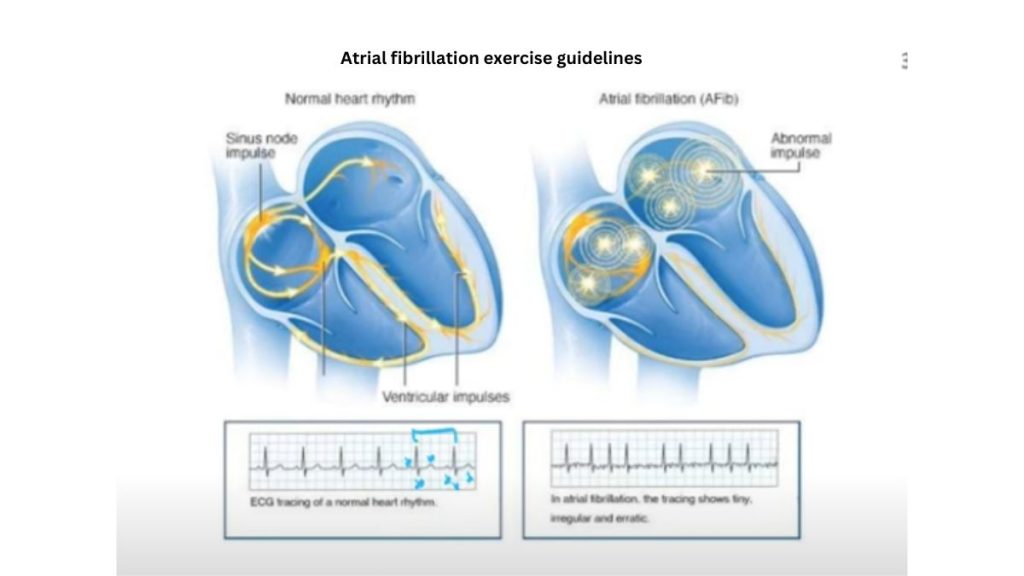 Atrial fibrillation exercise guidelines 