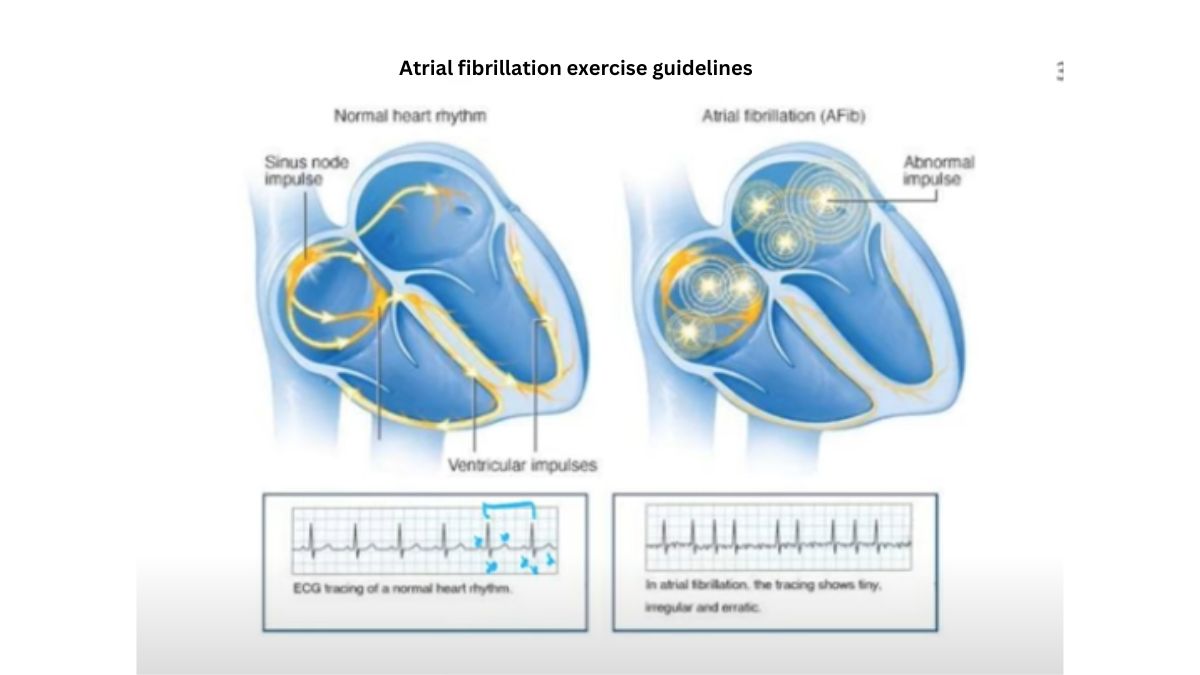 Atrial fibrillation exercise guidelines